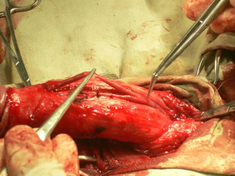 Penis-Lipofilling zur Vergrößerung